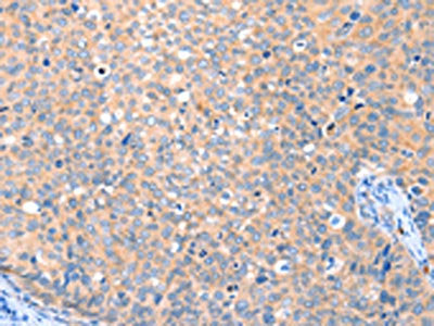 The image on the left is immunohistochemistry of paraffin-embedded Human cervical cancer tissue using the antibody Antibody) at dilution 1/20, on the right is treated with fusion protein. (Original magnification: ×200)Rabbit anti-Human VANGL1 Polyclonal Antibody