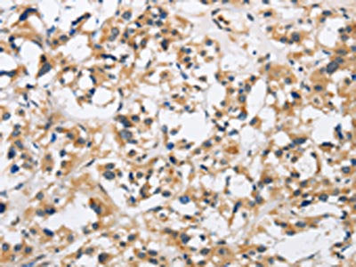 The image is immunohistochemistry of paraffin-embedded Human thyroid cancer tissue using CKMT2 Antibody(CKMT2 Antibody) at dilution 1/60. (Original magnification: ×200)Rabbit anti-Human CKMT2 Polyclonal Antibody