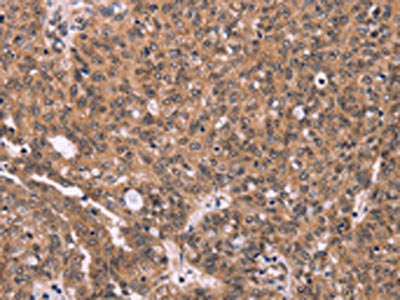 The image on the left is immunohistochemistry of paraffin-embedded Human ovarian cancer tissue using ERAS Antibody(ERAS Antibody) at dilution 1/40, on the right is treated with synthetic peptide. (Original magnification: ×200)Rabbit anti-Human ERAS Polyclonal Antibody