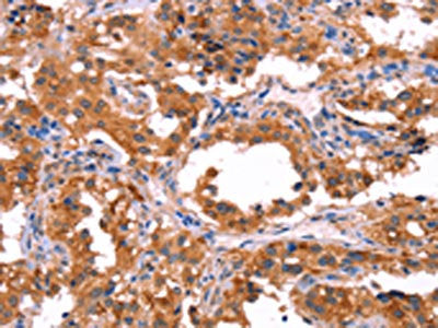 The image on the left is immunohistochemistry of paraffin-embedded Human thyroid cancer tissue using the antibody Antibody) at dilution 1/40, on the right is treated with synthetic peptide. (Original magnification: ×200)Rabbit anti-Human ERAS Polyclonal Antibody
