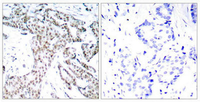 Immunohistochemical analysis of paraffin-embedded human breast carcinoma tissue using STAT3(Phospho-Ser727) Antibody(left) or the same antibody preincubated with blocking peptide(right).Rabbit anti-Human STAT3 Polyclonal Antibody