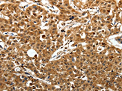 The image on the left is immunohistochemistry of paraffin-embedded Human lung cancer tissue using SOX13 Antibody(SOX13 Antibody) at dilution 1/50, on the right is treated with synthetic peptide. (Original magnification: ×200)Rabbit anti-Human SOX13 Polyclonal Antibody