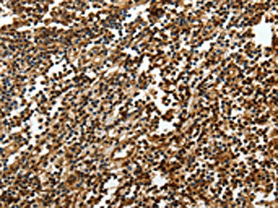 The image on the left is immunohistochemistry of paraffin-embedded Human tonsil tissue using the antibody Antibody) at dilution 1/50, on the right is treated with synthetic peptide. (Original magnification: ×200)Rabbit anti-Human SOX13 Polyclonal Antibody