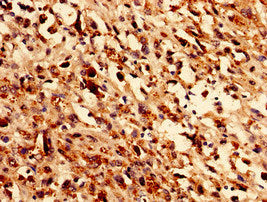 Immunocytochemistry analysis of human melanoma using GLE1 Antibody at dilution of 1:100Rabbit anti-Human GLE1 Polyclonal Antibody