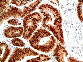 Immunohistochemical analysis of paraffin-embedded Human Colon Carcinoma Tissue using HSP40 Rabbit  pAb diluted at 1:200Rabbit anti-Human DNAJB1 Polyclonal Antibody