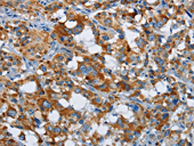 The image on the left is immunohistochemistry of paraffin-embedded Human thyroid cancer tissue using ETHE1 Antibody(ETHE1 Antibody) at dilution 1/20, on the right is treated with fusion protein. (Original magnification: ×200)Rabbit anti-Human ETHE1 Polyclonal Antibody