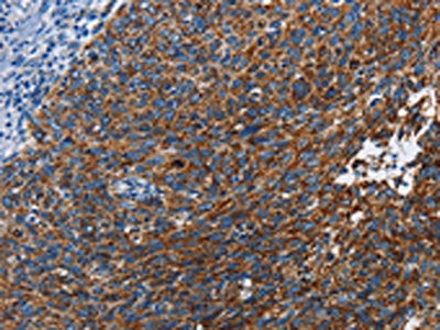 The image on the left is immunohistochemistry of paraffin-embedded Human cervical cancer tissue using the antibody Antibody) at dilution 1/20, on the right is treated with fusion protein. (Original magnification: ×200)Rabbit anti-Human ETHE1 Polyclonal Antibody