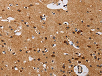 The image on the left is immunohistochemistry of paraffin-embedded Human brain  tissue using IL17RA Antibody(IL17RA Antibody) at dilution 1/40, on the right is treated with synthetic peptide. (Original magnification: ×200)Rabbit anti-Human IL17RA Polyclonal Antibody