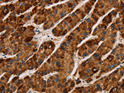 The image on the left is immunohistochemistry of paraffin-embedded Human liver cancer tissue using the antibody Antibody) at dilution 1/40, on the right is treated with synthetic peptide. (Original magnification: ×200)