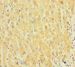 Immunohistochemistry of paraffin-embedded human liver cancer using SPIN4 Antibody at dilution of 1:100Rabbit anti-Human SPIN4 Polyclonal Antibody