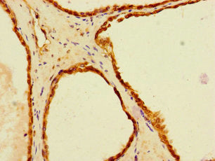 Immunohistochemistry of paraffin-embedded human prostate cancer using LACTB2 Antibody at dilution of 1:100