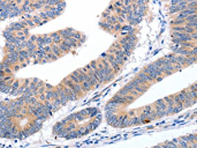 The image on the left is immunohistochemistry of paraffin-embedded Human colon cancer tissue using CMTM3 Antibody(CMTM3 Antibody) at dilution 1/10, on the right is treated with synthetic peptide. (Original magnification: ×200)Rabbit anti-Human CMTM3 Polyclonal Antibody