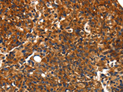 The image on the left is immunohistochemistry of paraffin-embedded Human breast cancer tissue using the antibody Antibody) at dilution 1/10, on the right is treated with synthetic peptide. (Original magnification: ×200)Rabbit anti-Human CMTM3 Polyclonal Antibody