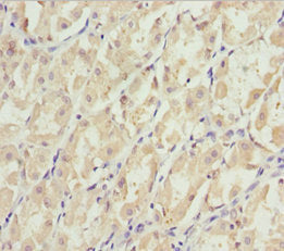 Immunohistochemistry of paraffin-embedded human gastric cancer using EFHC1 Antibody at dilution of 1:100Rabbit anti-Human EFHC1 Polyclonal Antibody