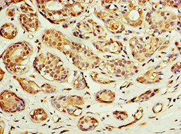 Immunohistochemistry of paraffin-embedded human breast cancer using ACSM3 Antibody at dilution of 1:100
