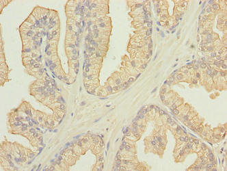 Immunohistochemistry of paraffin-embedded human prostate cancer using FAM78A Antibody at dilution of 1:100Rabbit anti-Human FAM78A Polyclonal Antibody