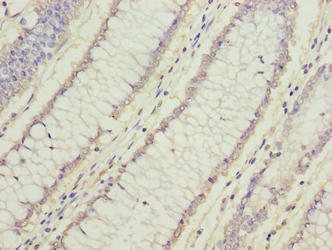 Immunohistochemistry of paraffin-embedded human colon cancer using FAM78A Antibody at dilution of 1:100Rabbit anti-Human FAM78A Polyclonal Antibody