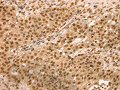 The image on the left is immunohistochemistry of paraffin-embedded Human breast cancer tissue using SNX8 Antibody(SNX8 Antibody) at dilution 1/25, on the right is treated with fusion protein. (Original magnification: ×200)Rabbit anti-Human SNX8 Polyclonal Antibody