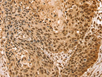 The image on the left is immunohistochemistry of paraffin-embedded Human esophagus cancer tissue using the antibody Antibody) at dilution 1/25, on the right is treated with fusion protein. (Original magnification: ×200)Rabbit anti-Human SNX8 Polyclonal Antibody