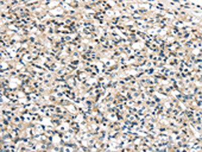 The image on the left is immunohistochemistry of paraffin-embedded Human prostate cancer tissue using VPS26A Antibody(VPS26A Antibody) at dilution 1/35, on the right is treated with synthetic peptide. (Original magnification: ×200)Rabbit anti-Human VPS26A Polyclonal Antibody