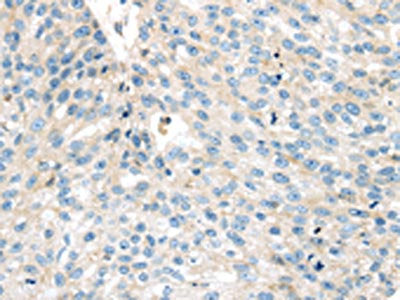 The image on the left is immunohistochemistry of paraffin-embedded Human breast cancer tissue using the antibody Antibody) at dilution 1/35, on the right is treated with synthetic peptide. (Original magnification: ×200)Rabbit anti-Human VPS26A Polyclonal Antibody