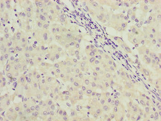 Immunohistochemistry of paraffin-embedded human liver cancer using C9orf64 Antibody at dilution of 1:100