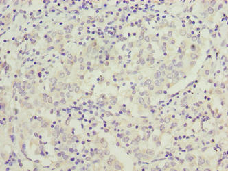 Immunohistochemistry of paraffin-embedded human lung cancer using C9orf64 Antibody at dilution of 1:100