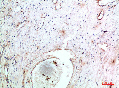 Immunohistochemical analysis of paraffin-embedded human-cervical-cancer, antibody was diluted at 1:200Rabbit anti-Human TNIP2 Polyclonal Antibody
