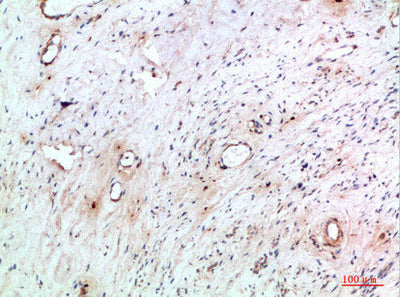 Immunohistochemical analysis of paraffin-embedded human-cervical-cancer, antibody was diluted at 1:200Rabbit anti-Human TNIP2 Polyclonal Antibody