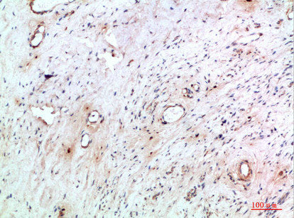 Immunohistochemical analysis of paraffin-embedded human-cervical-cancer, antibody was diluted at 1:200Rabbit anti-Human TNIP2 Polyclonal Antibody