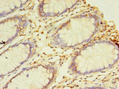 Immunohistochemistry of paraffin-embedded human colon cancer using NAIF1 Antibody at dilution of 1:100Rabbit anti-Human NAIF1 Polyclonal Antibody