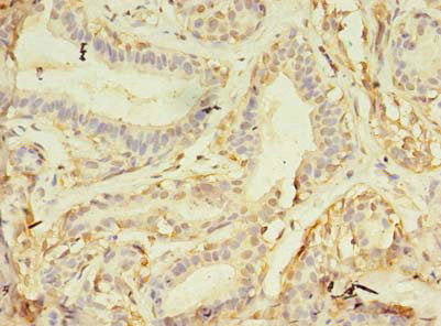 Immunohistochemistry of paraffin-embedded human breast cancer using NAIF1 Antibody at dilution of 1:100Rabbit anti-Human NAIF1 Polyclonal Antibody