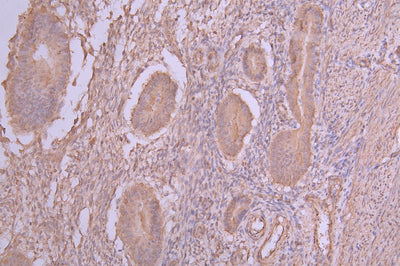 IHC image of PLEKHS1 Antibody diluted at 1:66 and staining in paraffin-embedded human endometrial cancer performed on a Leica BondTM system. After dewaxing and hydration, antigen retrieval was mediated by high pressure in a citrate buffer (pH 6.0). Section was blocked with 10% normal goat serum 30min at RT. Then primary antibody (1% BSA) was incubated at 4°C overnight. The primary is detected by a Goat anti-rabbit polymer IgG labeled by HRP and visualized using 0.05% DAB.Rabbit anti-Human PLEKHS1 Polyclonal Antibody