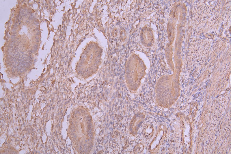 IHC image of PLEKHS1 Antibody diluted at 1:66 and staining in paraffin-embedded human endometrial cancer performed on a Leica BondTM system. After dewaxing and hydration, antigen retrieval was mediated by high pressure in a citrate buffer (pH 6.0). Section was blocked with 10% normal goat serum 30min at RT. Then primary antibody (1% BSA) was incubated at 4°C overnight. The primary is detected by a Goat anti-rabbit polymer IgG labeled by HRP and visualized using 0.05% DAB.Rabbit anti-Human PLEKHS1 Polyclonal Antibody