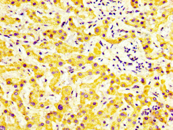 IHC image of MYBPC1 Antibody diluted at 1:600 and staining in paraffin-embedded human liver cancer performed on a Leica BondTM system. After dewaxing and hydration, antigen retrieval was mediated by high pressure in a citrate buffer (pH 6.0). Section was blocked with 10% normal goat serum 30min at RT. Then primary antibody (1% BSA) was incubated at 4°C overnight. The primary is detected by a biotinylated secondary antibody and visualized using an HRP conjugated SP system.Rabbit anti-Human MYBPC1 Polyclonal Antibody