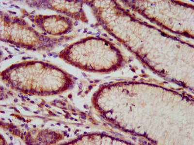 IHC image of the antibody diluted at 1:800 and staining in paraffin-embedded human gastric cancer performed on a Leica BondTM system. After dewaxing and hydration, antigen retrieval was mediated by high pressure in a citrate buffer (pH 6.0). Section was blocked with 10% normal goat serum 30min at RT. Then primary antibody (1% BSA) was incubated at 4°C overnight. The primary is detected by a biotinylated secondary antibody and visualized using an HRP conjugated SP system.Rabbit anti-Human RNF213 Polyclonal Antibody
