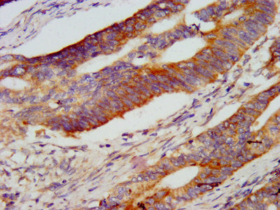 IHC image of RNF213 Antibody diluted at 1:800 and staining in paraffin-embedded human colon cancer performed on a Leica BondTM system. After dewaxing and hydration, antigen retrieval was mediated by high pressure in a citrate buffer (pH 6.0). Section was blocked with 10% normal goat serum 30min at RT. Then primary antibody (1% BSA) was incubated at 4°C overnight. The primary is detected by a biotinylated secondary antibody and visualized using an HRP conjugated SP system.Rabbit anti-Human RNF213 Polyclonal Antibody