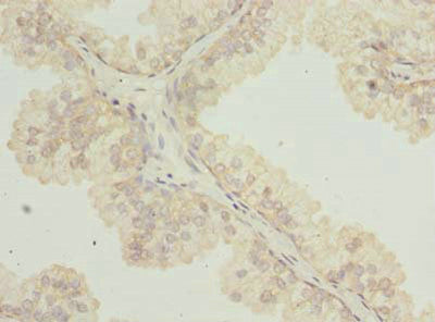 Immunohistochemistry of paraffin-embedded human prostate cancer using TTC38 Antibody at dilution of 1:100Rabbit anti-Human TTC38 Polyclonal Antibody