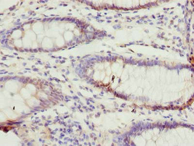 Immunohistochemistry of paraffin-embedded human colon cancer using TTC38 Antibody at dilution of 1:100Rabbit anti-Human TTC38 Polyclonal Antibody