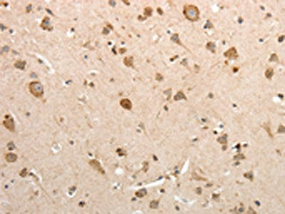 The image on the left is immunohistochemistry of paraffin-embedded Human brain tissue using SLC12A1 Antibody(SLC12A1 Antibody) at dilution 1/15, on the right is treated with fusion protein. (Original magnification: ×200)Rabbit anti-Human SLC12A1 Polyclonal Antibody