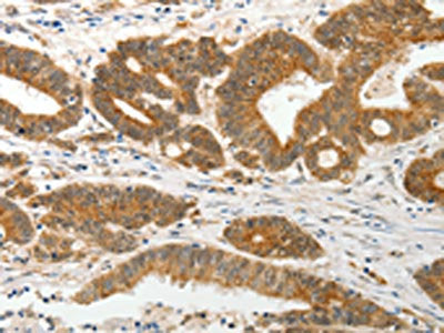 The image on the left is immunohistochemistry of paraffin-embedded Human colon cancer tissue using the antibody Antibody) at dilution 1/15, on the right is treated with fusion protein. (Original magnification: ×200)Rabbit anti-Human SLC12A1 Polyclonal Antibody