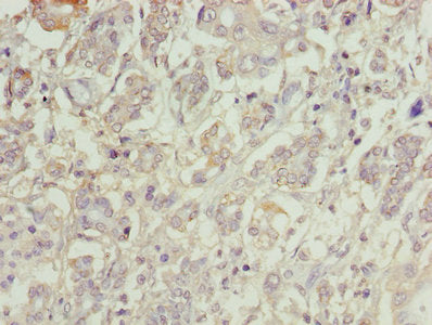 Immunohistochemistry of paraffin-embedded human pancreatic cancer using CATSPERE Antibody at dilution of 1:100