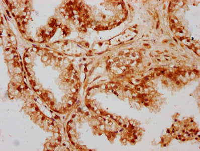 IHC image of the antibody diluted at 1:300 and staining in paraffin-embedded human prostate cancer performed on a Leica BondTM system. After dewaxing and hydration, antigen retrieval was mediated by high pressure in a citrate buffer (pH 6.0). Section was blocked with 10% normal goat serum 30min at RT. Then primary antibody (1% BSA) was incubated at 4°C overnight. The primary is detected by a biotinylated secondary antibody and visualized using an HRP conjugated SP system.Rabbit anti-Human CPTP Polyclonal Antibody