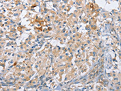 The image on the left is immunohistochemistry of paraffin-embedded Human thyroid cancer tissue using CENPE Antibody(CENPE Antibody) at dilution 1/50, on the right is treated with synthetic peptide. (Original magnification: ×200)Rabbit anti-Human CENPE Polyclonal Antibody