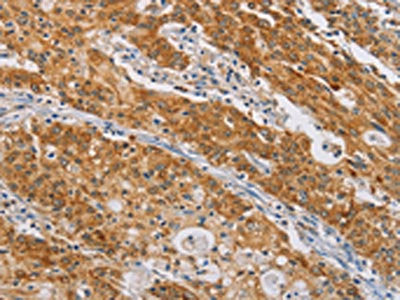 The image on the left is immunohistochemistry of paraffin-embedded Human gastic cancer tissue using the antibody Antibody) at dilution 1/50, on the right is treated with synthetic peptide. (Original magnification: ×200)Rabbit anti-Human CENPE Polyclonal Antibody