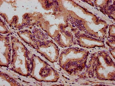 IHC image of IBA57 Antibody diluted at 1:400 and staining in paraffin-embedded human prostate tissue performed on a Leica BondTM system. After dewaxing and hydration, antigen retrieval was mediated by high pressure in a citrate buffer (pH 6.0). Section was blocked with 10% normal goat serum 30min at RT. Then primary antibody (1% BSA) was incubated at 4°C overnight. The primary is detected by a biotinylated secondary antibody and visualized using an HRP conjugated SP system.