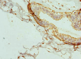 Immunohistochemistry of paraffin-embedded human breast cancer using INTS11 Antibody at dilution of 1:100