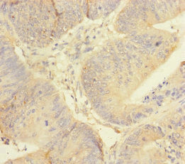 Immunohistochemistry of paraffin-embedded human colon cancer using REEP5 Antibody at dilution of 1:100Rabbit anti-Human REEP5 Polyclonal Antibody