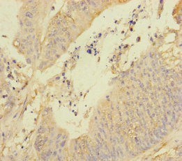 Immunohistochemistry of paraffin-embedded human colon cancer using REEP5 Antibody at dilution of 1:100Rabbit anti-Human REEP5 Polyclonal Antibody