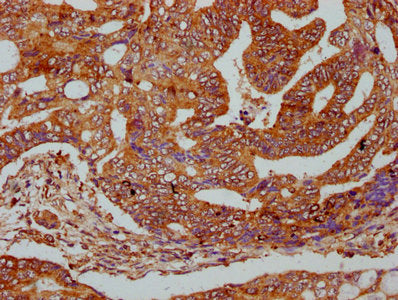IHC image of ODR4 Antibody diluted at 1:400 and staining in paraffin-embedded human colon cancer performed on a Leica BondTM system. After dewaxing and hydration, antigen retrieval was mediated by high pressure in a citrate buffer (pH 6.0). Section was blocked with 10% normal goat serum 30min at RT. Then primary antibody (1% BSA) was incubated at 4°C overnight. The primary is detected by a biotinylated secondary antibody and visualized using an HRP conjugated SP system.Rabbit anti-Human ODR4 Polyclonal Antibody